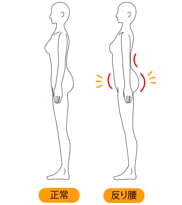 反り腰とは?